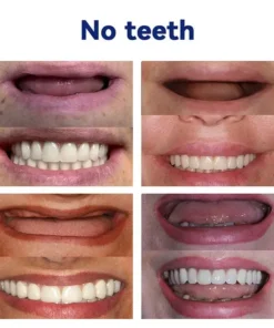 Bikenda™-🦷Advanced Customized Full Denture Set🦷