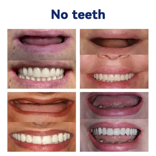 Bikenda™-🦷Advanced Customized Full Denture Set🦷