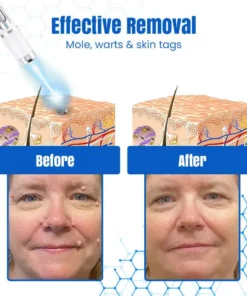 𝑩𝐢𝐤𝐞𝐧𝐝𝐚® 𝐃𝐞𝐫𝐦𝒁𝐚𝐩 𝑵𝐁-𝐔𝐕𝐁 𝑴𝐨𝐥𝐞 & 𝑾𝐚𝐫𝐭 𝑹𝐞𝐦𝐨𝐯𝐚𝐥 𝑷𝐡𝐨𝐭𝐨𝐭𝐡𝐞𝐫𝐚𝐩𝐲 𝑳𝐚𝐬𝐞𝐫 𝑷𝐞𝐧