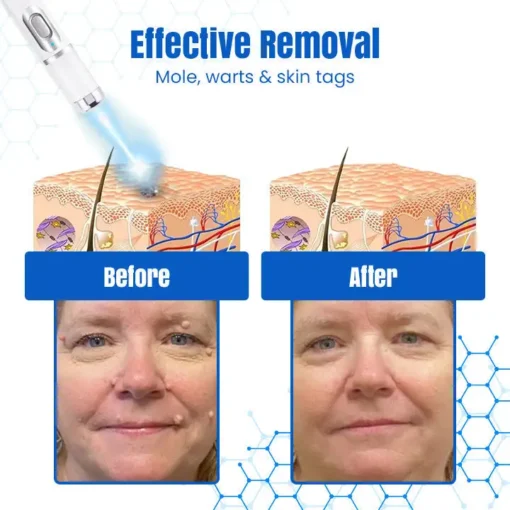 𝑩𝐢𝐤𝐞𝐧𝐝𝐚® 𝐃𝐞𝐫𝐦𝒁𝐚𝐩 𝑵𝐁-𝐔𝐕𝐁 𝑴𝐨𝐥𝐞 & 𝑾𝐚𝐫𝐭 𝑹𝐞𝐦𝐨𝐯𝐚𝐥 𝑷𝐡𝐨𝐭𝐨𝐭𝐡𝐞𝐫𝐚𝐩𝐲 𝑳𝐚𝐬𝐞𝐫 𝑷𝐞𝐧