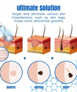 𝑩𝐢𝐤𝐞𝐧𝐝𝐚® 𝐃𝐞𝐫𝐦𝒁𝐚𝐩 𝑵𝐁-𝐔𝐕𝐁 𝑴𝐨𝐥𝐞 & 𝑾𝐚𝐫𝐭 𝑹𝐞𝐦𝐨𝐯𝐚𝐥 𝑷𝐡𝐨𝐭𝐨𝐭𝐡𝐞𝐫𝐚𝐩𝐲 𝑳𝐚𝐬𝐞𝐫 𝑷𝐞𝐧