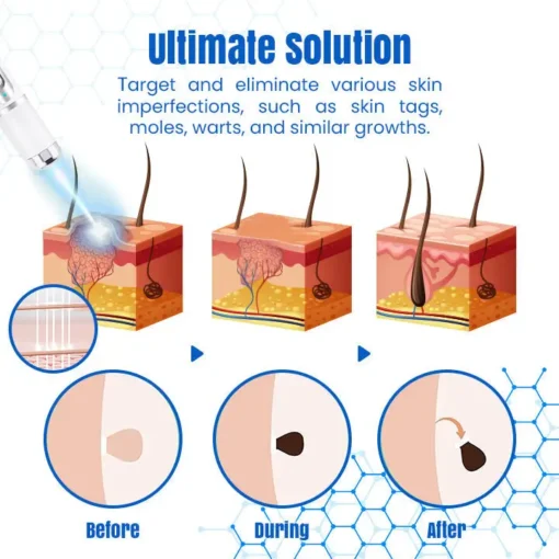 𝑩𝐢𝐤𝐞𝐧𝐝𝐚® 𝐃𝐞𝐫𝐦𝒁𝐚𝐩 𝑵𝐁-𝐔𝐕𝐁 𝑴𝐨𝐥𝐞 & 𝑾𝐚𝐫𝐭 𝑹𝐞𝐦𝐨𝐯𝐚𝐥 𝑷𝐡𝐨𝐭𝐨𝐭𝐡𝐞𝐫𝐚𝐩𝐲 𝑳𝐚𝐬𝐞𝐫 𝑷𝐞𝐧