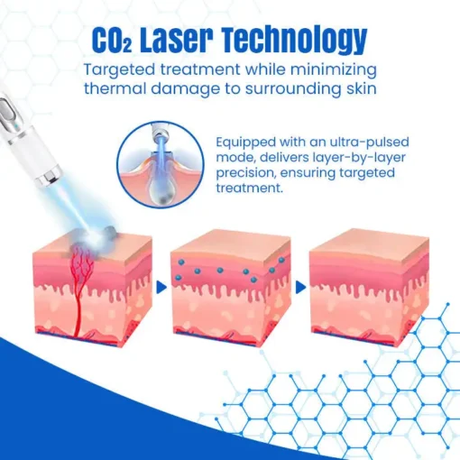 𝑩𝐢𝐤𝐞𝐧𝐝𝐚® 𝐃𝐞𝐫𝐦𝒁𝐚𝐩 𝑵𝐁-𝐔𝐕𝐁 𝑴𝐨𝐥𝐞 & 𝑾𝐚𝐫𝐭 𝑹𝐞𝐦𝐨𝐯𝐚𝐥 𝑷𝐡𝐨𝐭𝐨𝐭𝐡𝐞𝐫𝐚𝐩𝐲 𝑳𝐚𝐬𝐞𝐫 𝑷𝐞𝐧