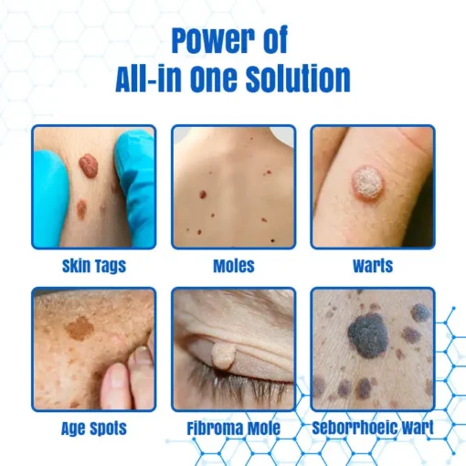 𝑩𝐢𝐤𝐞𝐧𝐝𝐚® 𝐃𝐞𝐫𝐦𝒁𝐚𝐩 𝑵𝐁-𝐔𝐕𝐁 𝑴𝐨𝐥𝐞 & 𝑾𝐚𝐫𝐭 𝑹𝐞𝐦𝐨𝐯𝐚𝐥 𝑷𝐡𝐨𝐭𝐨𝐭𝐡𝐞𝐫𝐚𝐩𝐲 𝑳𝐚𝐬𝐞𝐫 𝑷𝐞𝐧