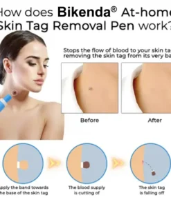 Bikenda® At-home Skin Tag Removal Pen