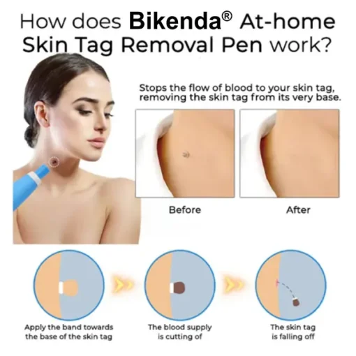 Bikenda® At-home Skin Tag Removal Pen