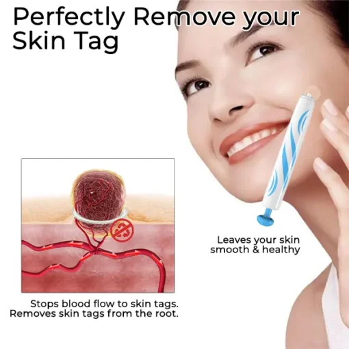 Bikenda® At-home Skin Tag Removal Pen