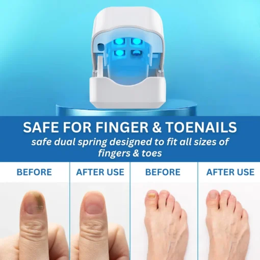 Bikenda® Nail Fungus Laser Treatment Device