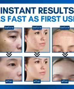 Bikenda® Skin Tag Treatment Pen