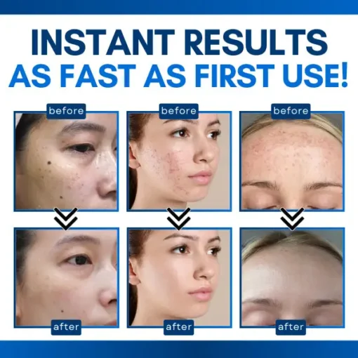 Bikenda® Skin Tag Treatment Pen