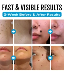 Bikenda® SpotlessDerm Mole and Wart Laser Pen