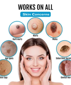 Bikenda® SpotlessDerm Mole and Wart Laser Pen