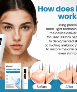 Bikenda® DermaBeam Vitiligo Therapy device
