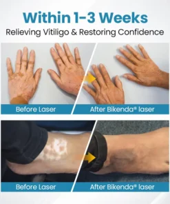 Bikenda® DermaBeam Vitiligo Therapy device