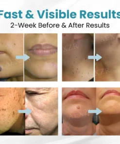 Bikenda® LUXE Non-Invasive Mole and Wart Removal Laser Pen