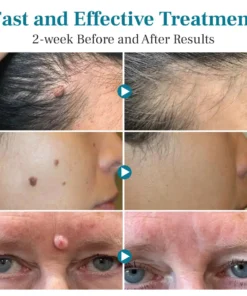 Bikenda® LumeSkin Mole and Wart Removal Laser Pen