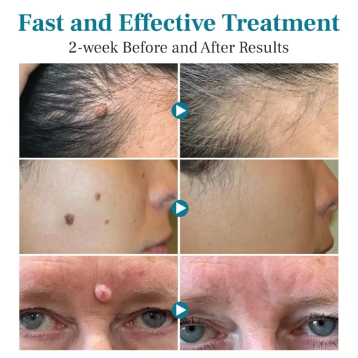 Bikenda® LumeSkin Mole and Wart Removal Laser Pen