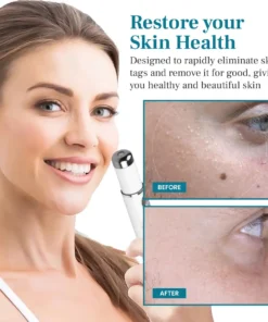 Bikenda® LumeSkin Mole and Wart Removal Laser Pen