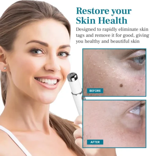 Bikenda® LumeSkin Mole and Wart Removal Laser Pen