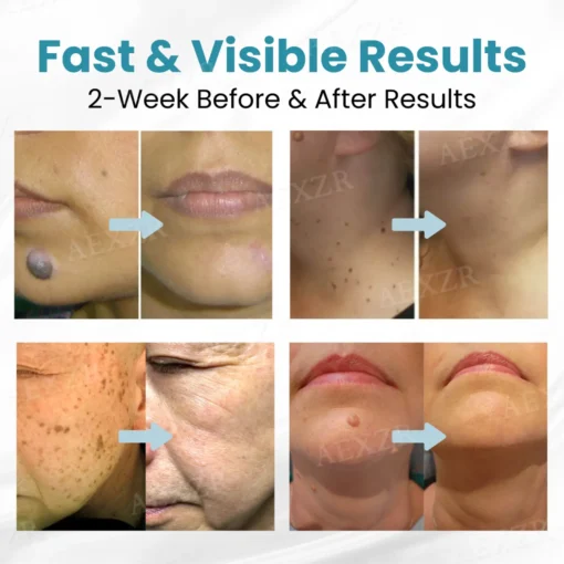 Bikenda® Professional Non-Invasive Mole and Wart Removal Laser Pen