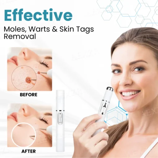 Bikenda® Professional Non-Invasive Mole and Wart Removal Laser Pen