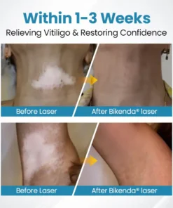 Bikenda® Evena Vitiligo Therapy Device