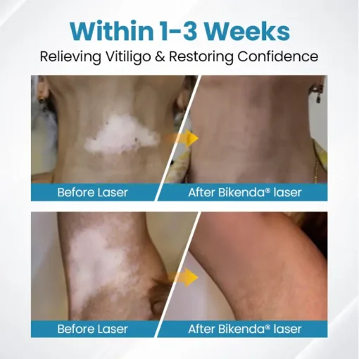 Bikenda® Evena Vitiligo Therapy Device