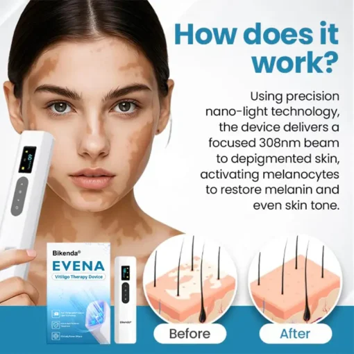 Bikenda® Evena Vitiligo Therapy Device