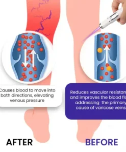 Bikenda® Varicose Vein Photothermal Laser Treatment