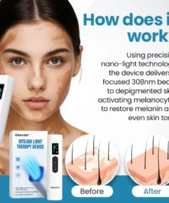 Bikenda® Vitiligo Light Therapy Device
