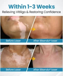 Bikenda® Vitiligo Light Therapy Device