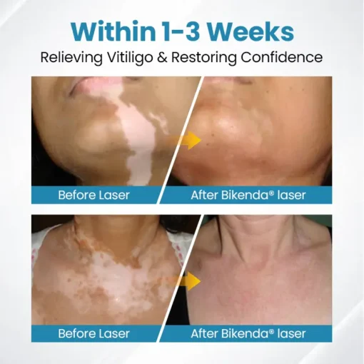 Bikenda® Vitiligo Light Therapy Device