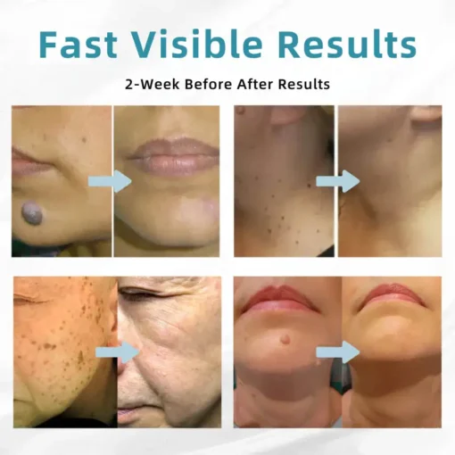 Bikenda® 𝒱𝑒𝓁𝓋𝑒𝓉𝒮𝓀𝒾𝓃+ All-in-One Laser Eraser Pen