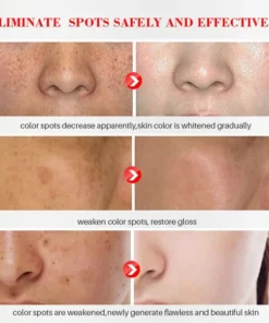 Bikenda™ Blemish Removing Beauty Cream