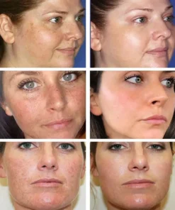 Bikenda™ Blemish Removing Beauty Cream