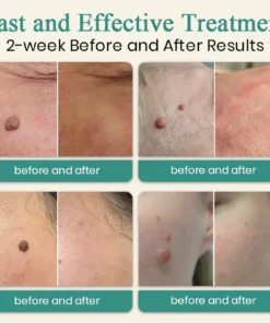 Bikenda® Mole and Wart Instant Removal Laser Pen