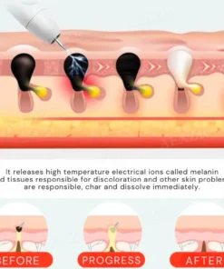 Bikenda® Portable Skin Care Laser Pen