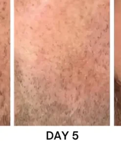 Bikenda® Portable Skin Care Laser Pen